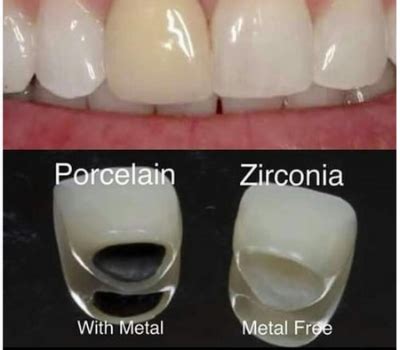 fabrication of metal ceramic crown|metal crown vs zirconia.